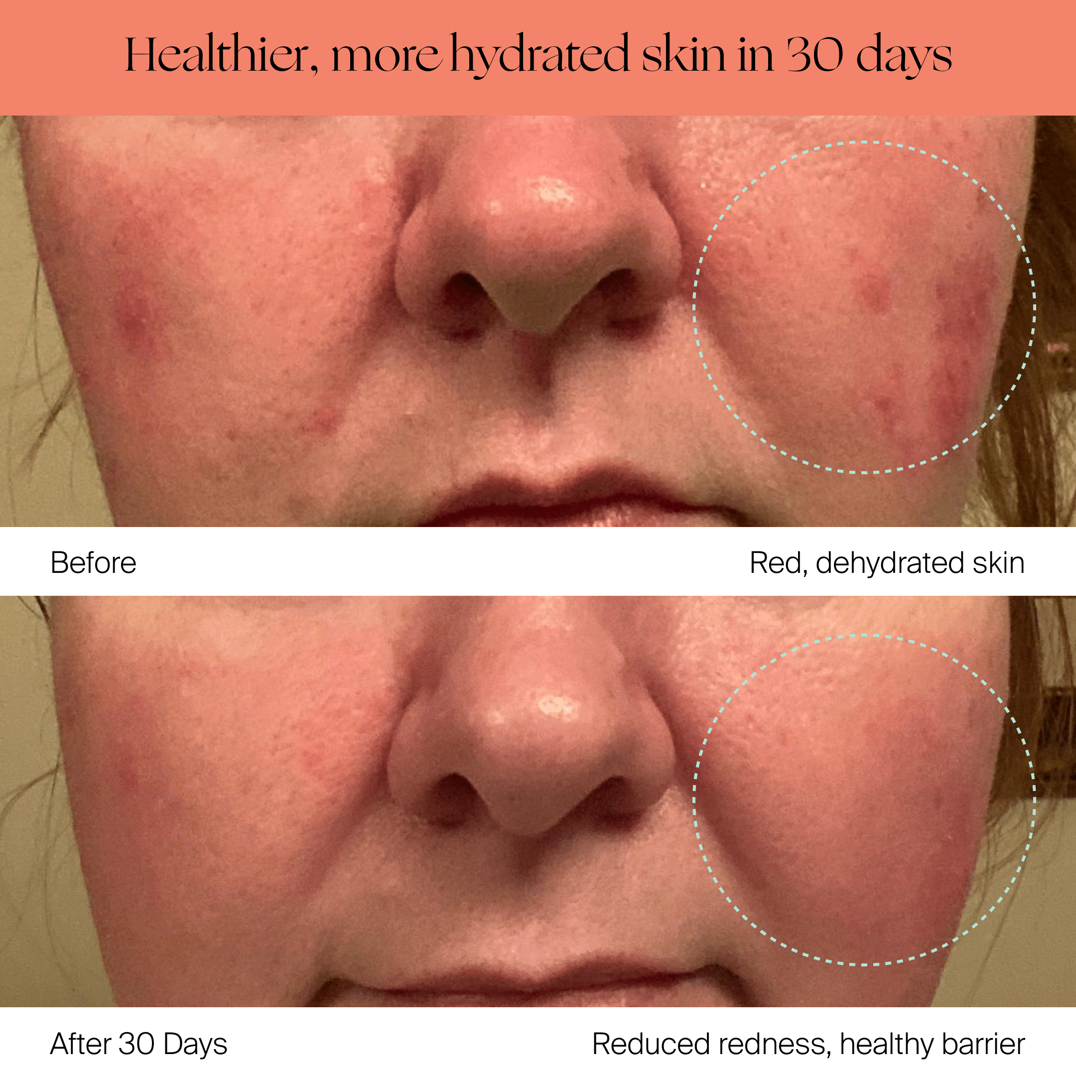 Canopy Humidifier - Skin Hydration Results